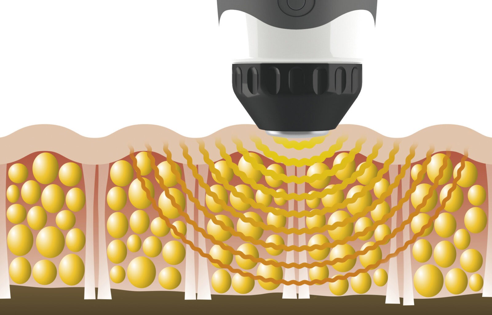 Acoustic Wave Therapy (AWT)